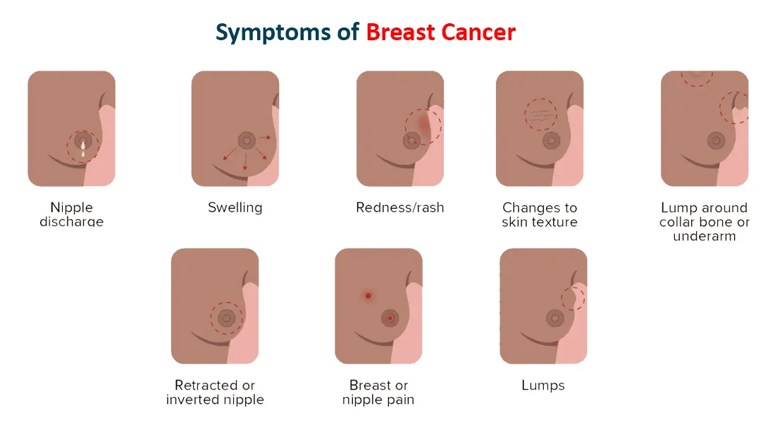  Symptoms of Breast Cancer